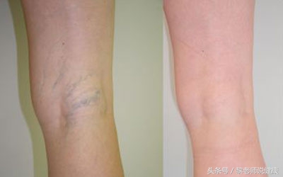 青筋很明显意味着什么,青筋凸起真的有人手会青筋暴起吗