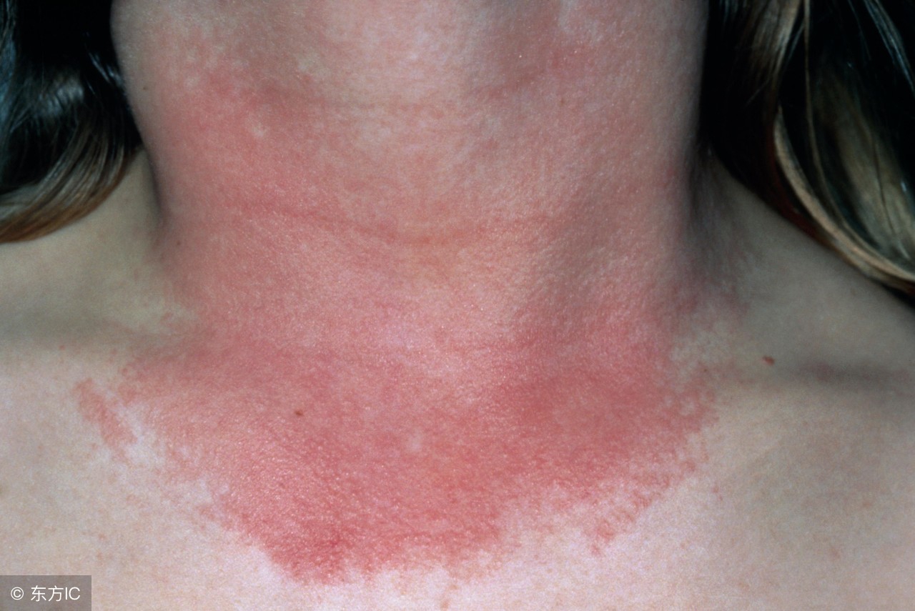 神经性皮炎图片大全大图,神经性皮炎防治指南