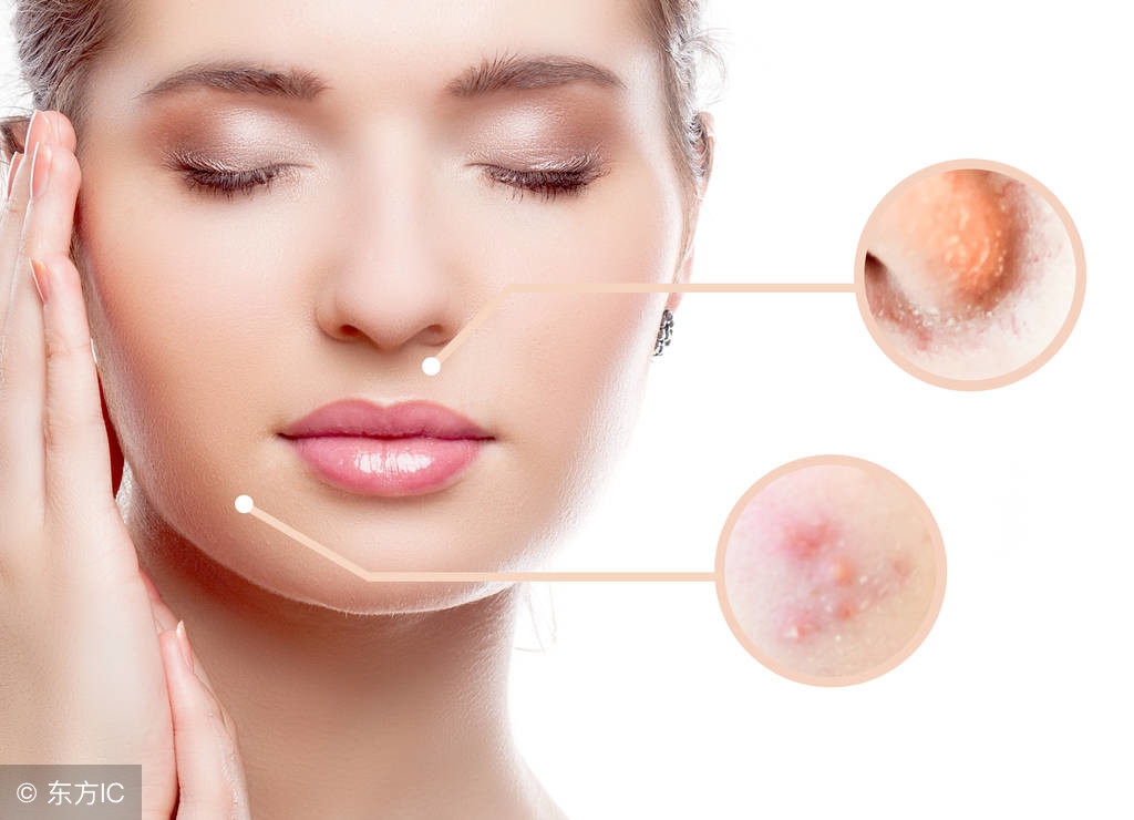 如何去除青春痘最快方法小妙招,怎么让青春痘快速去掉痘印