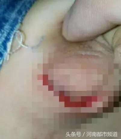 男孩被玻璃刺伤医生现场救治,7岁男孩被刀伤