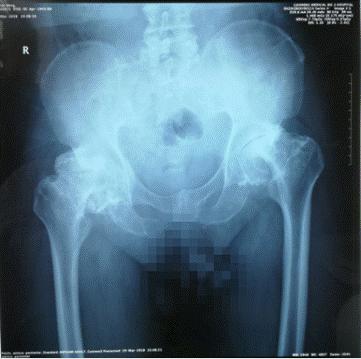 承德附属医院骨外科髋关节置换术,山西医大一院髋关节置换技术