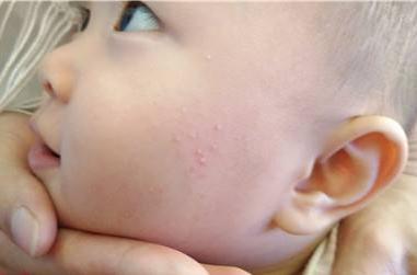 宝宝的湿疹让我绝望,婴儿湿疹太折磨人了家里一堆药