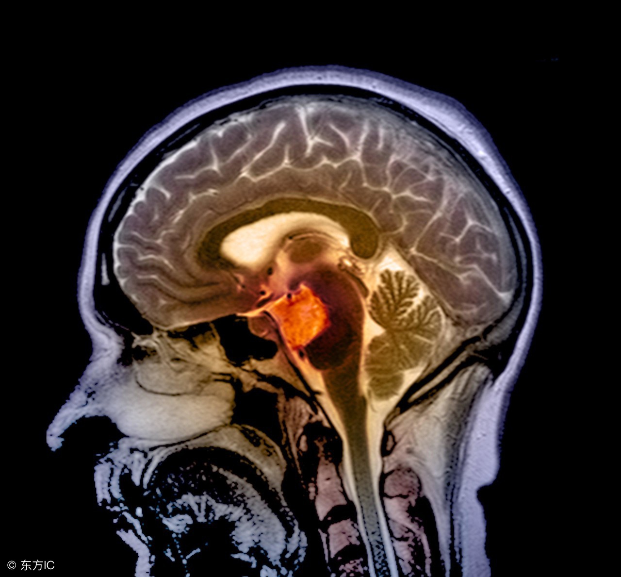 脑囊肿治疗有什么好的方法,脑囊肿手术哪家医院比较权威