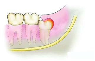 经常上火牙龈肿痛怎么办快速消肿,上火牙龈肿痛吃什么消炎药见效快