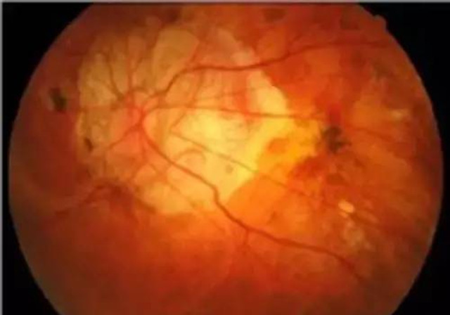 十一岁近视400度有多严重,小学生近视400度能矫正吗