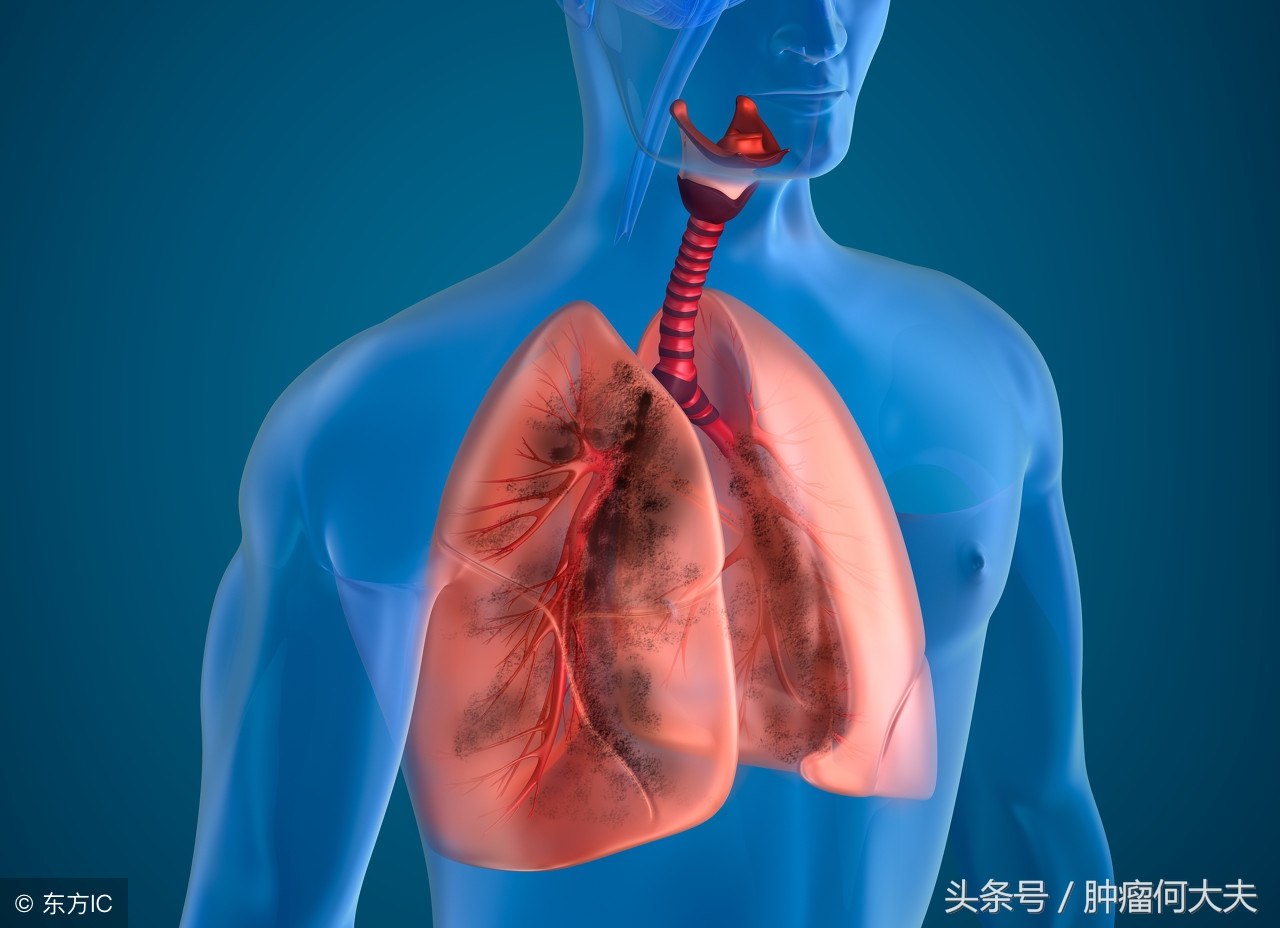 肺癌筛查最准的是用什么方法,肺癌筛查一定做肺穿刺吗