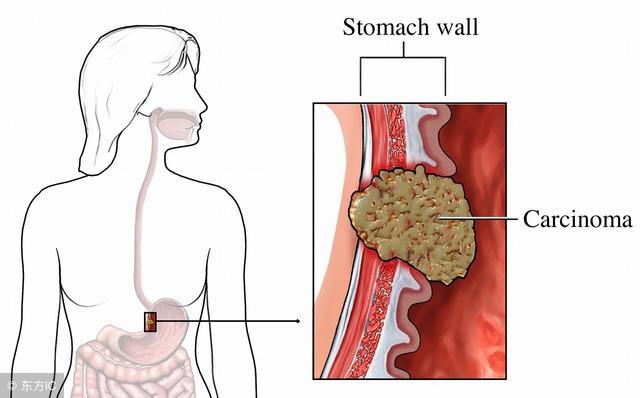 胃癌各临床分期治疗方案有哪些,胃癌怎么分期的