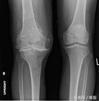 膝盖长期痛怎么办,膝盖痛有什么好方法治疗