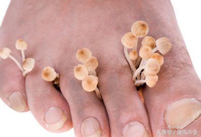 真菌无法根治么,真菌不能根治吗