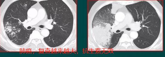 肺上肿块,肺上长出30cm肿块应该怎么办