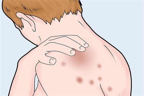 皮肤有红点怎么回事?(邯郸市丛台区中医院皮肤科)