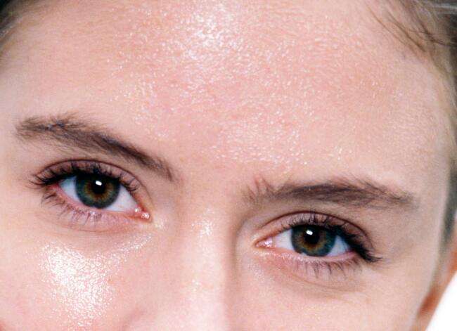 脸上长痘痘又红又肿,原因无非就是这3种,3招祛痘屡试不爽