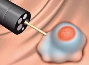 便血是什么原因引起的怎么治,什么是便血且血与粪便混合