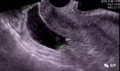 怎么分清盆腔积液是生理还是病理,盆腔积液怎么区分生理性和病理性