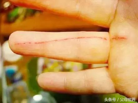 宝宝受伤用什么创可贴,宝宝受伤可以用创口贴吗