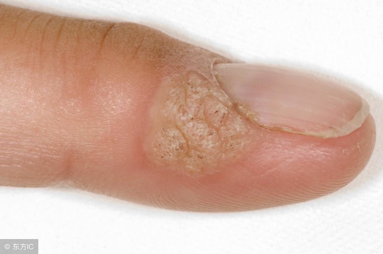 尖锐性湿疣早期发现能治好吗,尖锐性湿疣初期症状可以治愈吗