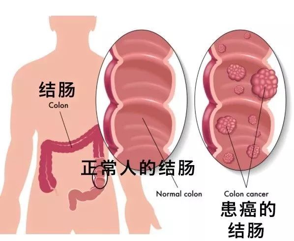 不是癌症,不是癌症的病能用免疫治疗吗