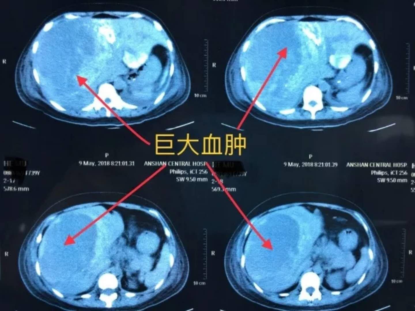 避孕药这3个副作用吃之前要知晓,避孕药吃了很多次会出现什么情况