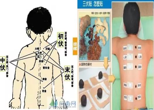 我院中西医结合科“冬病夏治”开始啦！