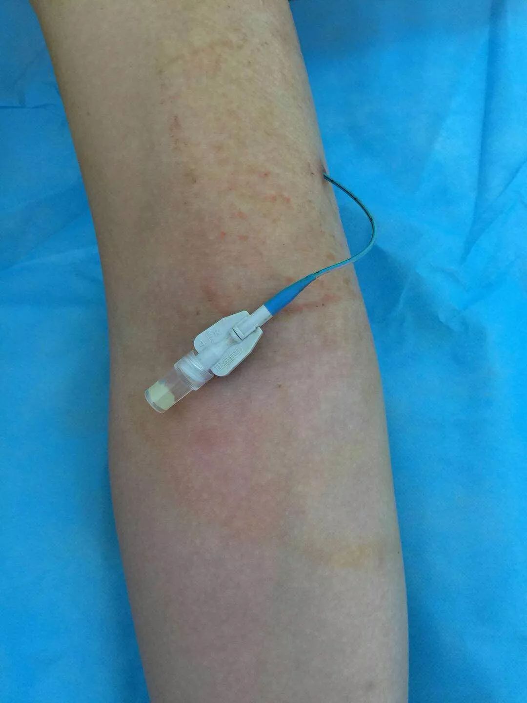 picc置管后周围肿胀原因及处理,picc管夏天怎么护理