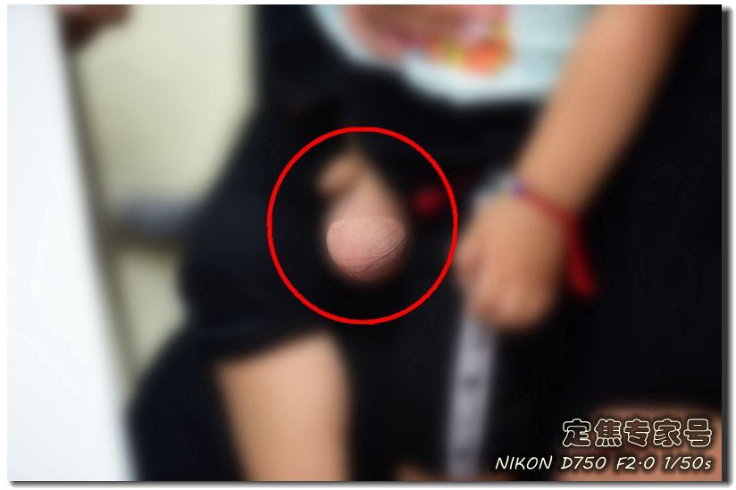 宝宝睾丸扭转能自动恢复过来吗,宝宝睾丸扭转