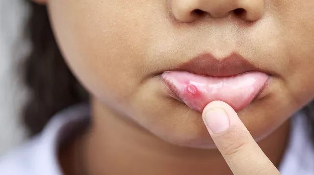 我做过最勇敢的事，就是咬破口腔溃疡