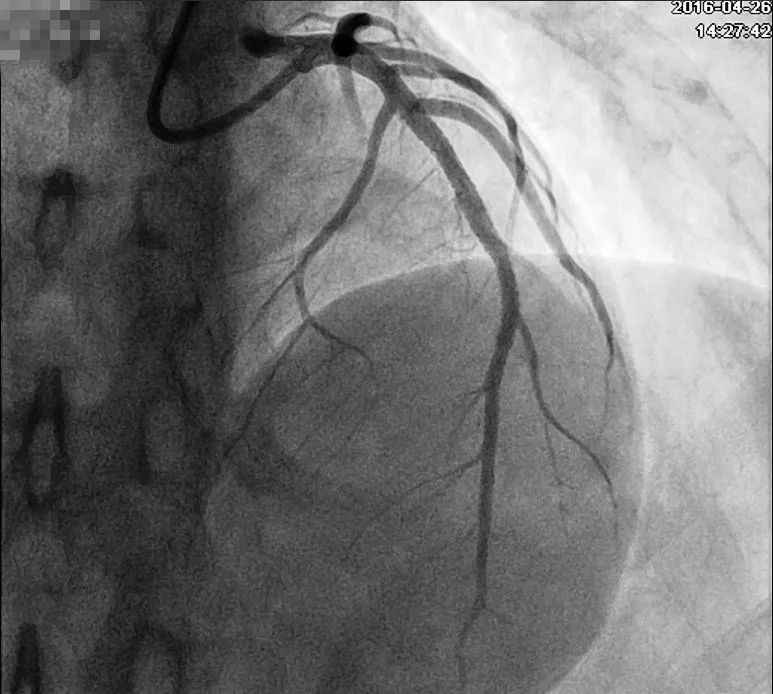 发作性胸痛心电图正常,心电图轻度T波改变图片