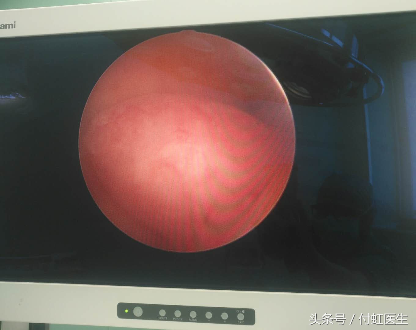 月经量多、乏力、头晕,原来是子宫内膜息肉惹的祸!