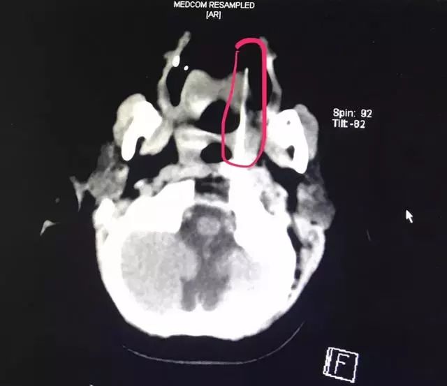 揪心！13厘米竹签插入两岁娃嘴里生命垂危！做家长的千万要注意！