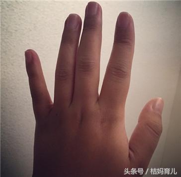 孕妇水肿吃什么东西消肿最快,宫内胎儿水肿孕妇吃什么可消肿