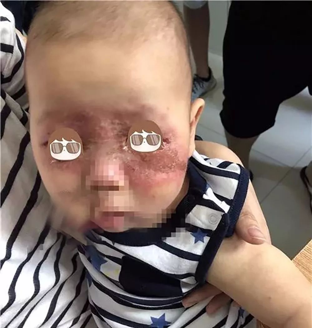 十几个月大的孩子因为它几乎毁容，夏天这两种虫要警惕……