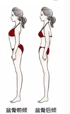 如何判断骨盆后倾还是骨盆前倾,骨盆前倾的日常原因