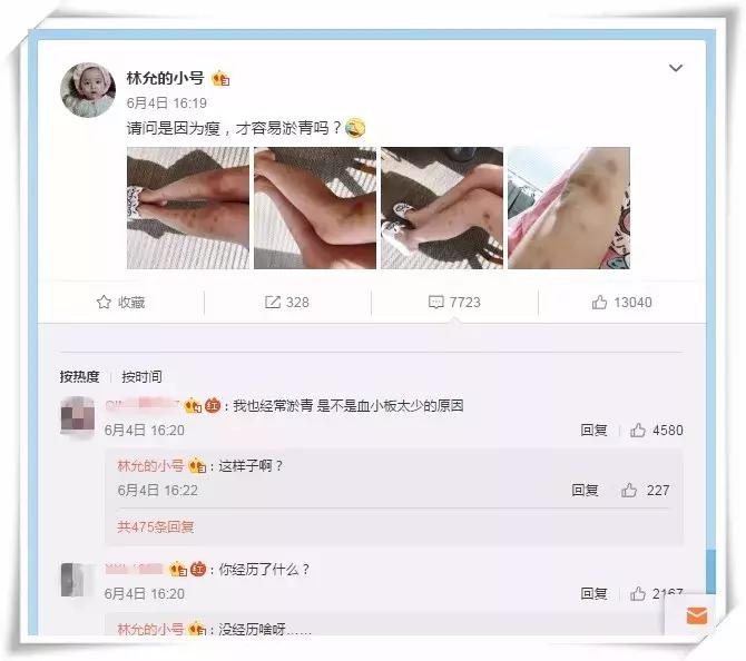 林允暴瘦照片,林允腿上的淤青原因