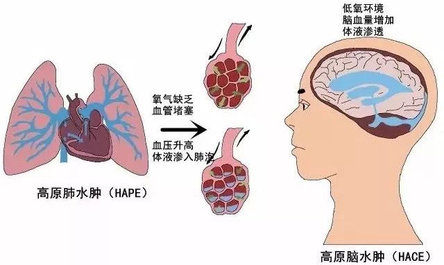 高反怎么化解,高反怎么办教你一招解决