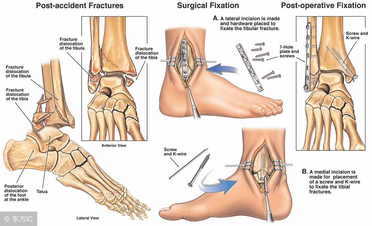 脚踝受伤后怎么消肿,脚踝康复训练冰敷后可以热敷吗