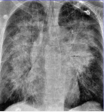 肺水肿和左心衰如何鉴别诊断,蝶翼征