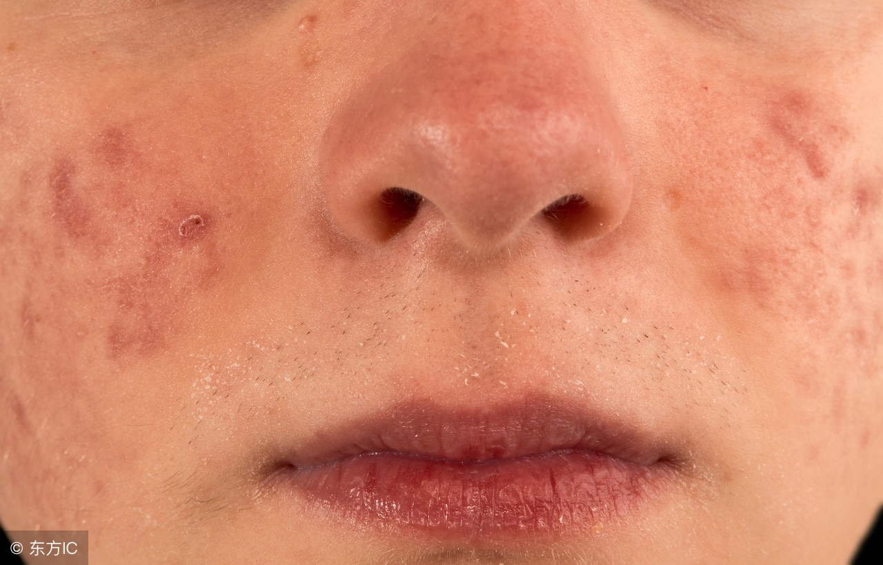 土茯苓外用治什么皮肤病特别好,土茯苓治疣效果好