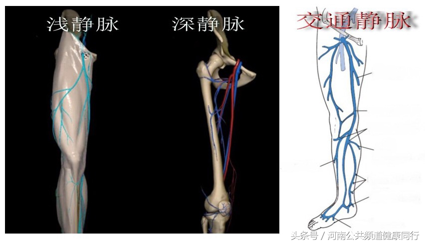 静脉曲张郑大一附院看哪个科,郑大一附院硬化剂治疗静脉曲张