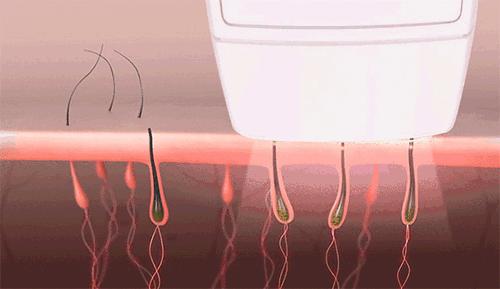 30分钟脱毛神器,最有效最实惠的脱毛神器