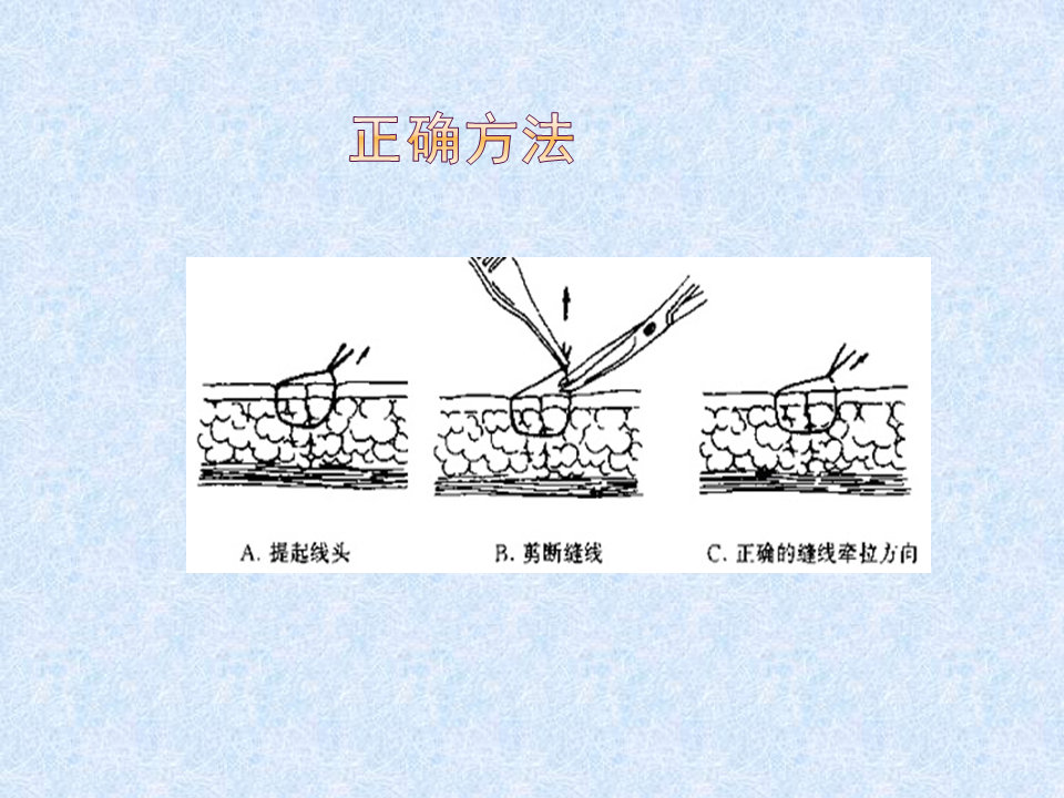 换药和拆线操作流程视频,换药拆线操作视频