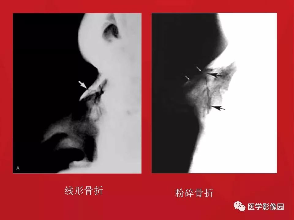 左侧鼻骨骨折伴鼻中隔骨折,双侧鼻骨及左上颌骨突骨折