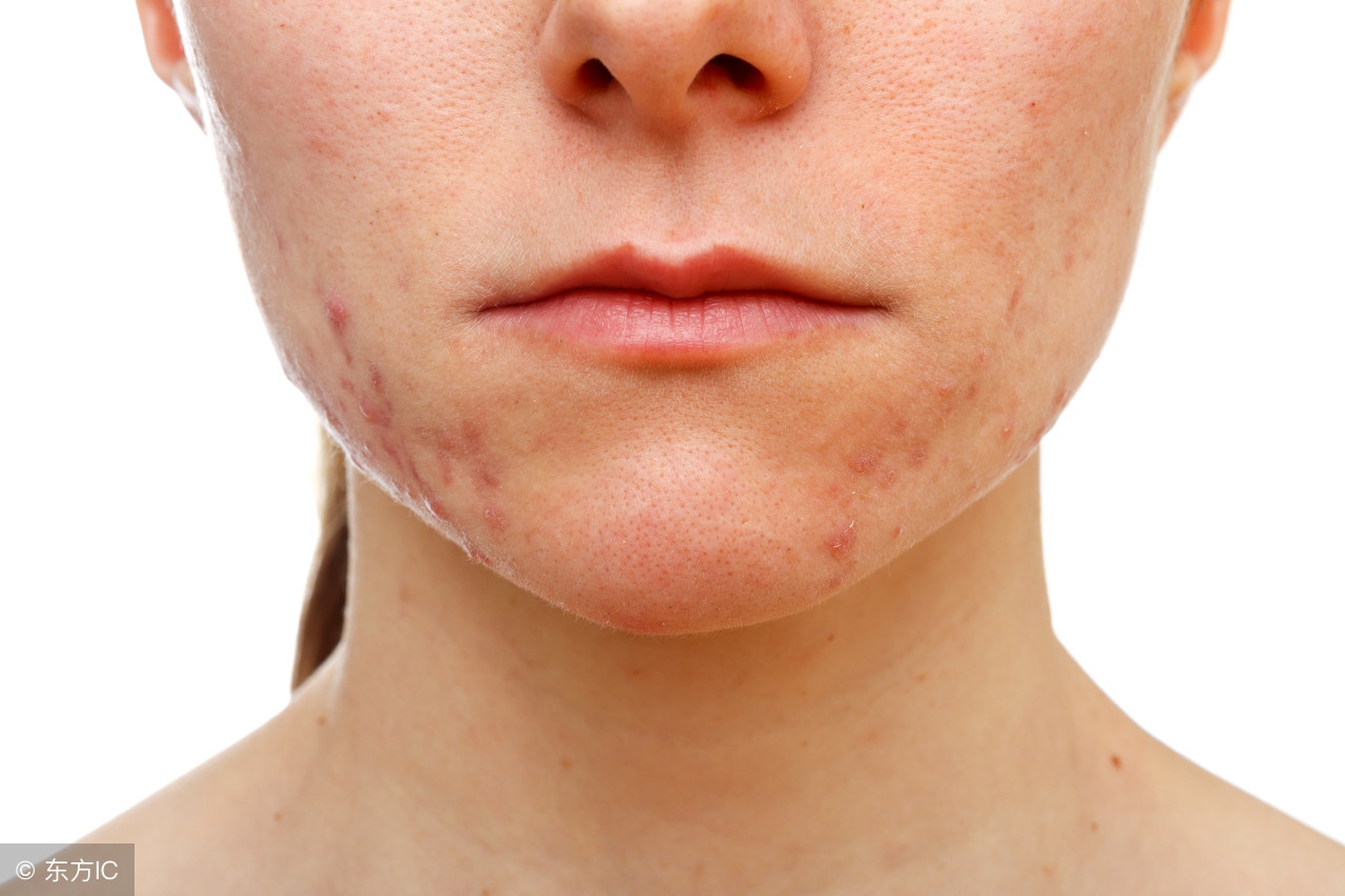 长玫瑰痤疮怎么治疗,鼻子长玫瑰痤疮怎么治疗