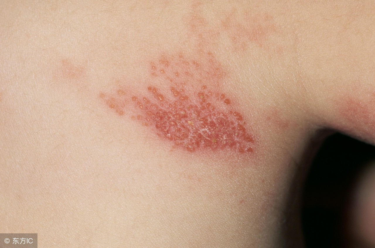带状疱疹注意什么，最大的痛苦是“瘙痒”