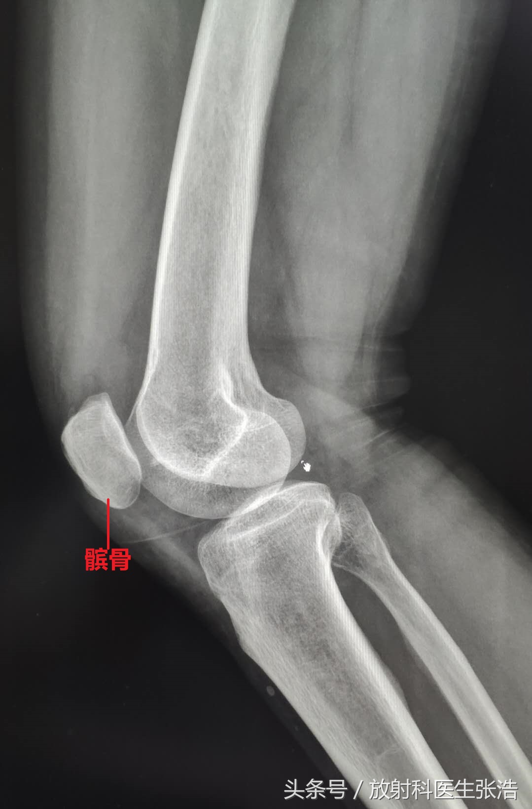膝关节疼照x光片有用吗,膝关节疼痛x光片能看出来吗