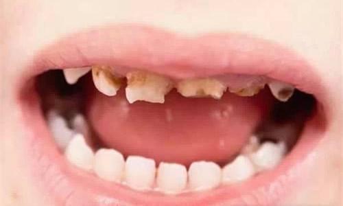 宝宝补牙全过程实操,宝宝束缚式补牙过程