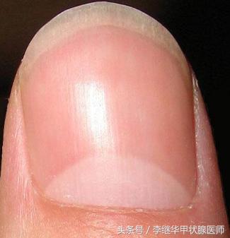 手指甲月牙越来越大代表什么,甲状腺手指月牙