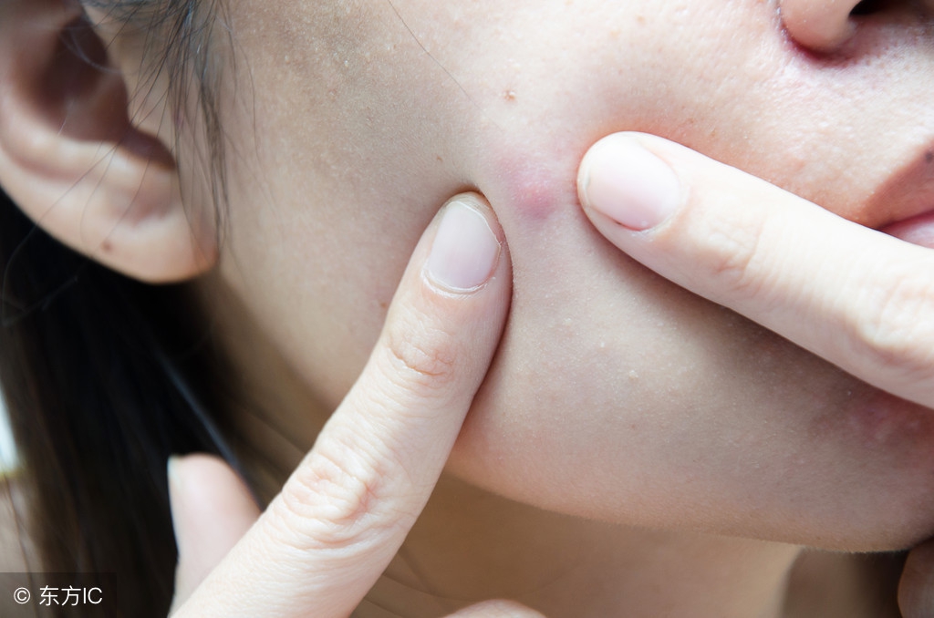 学生脸上痘痘去除小窍门,脸上长痘痘有什么办法彻底解决