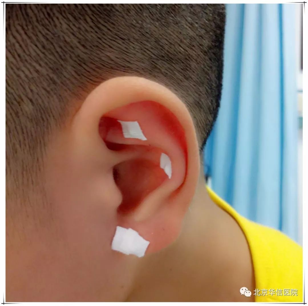 中医治疗小儿近视,中医小儿近视怎么调理