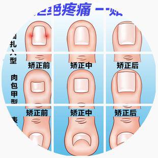 脚趾甲好痛怎么办,脚趾甲嵌入肉里垫棉花有效吗