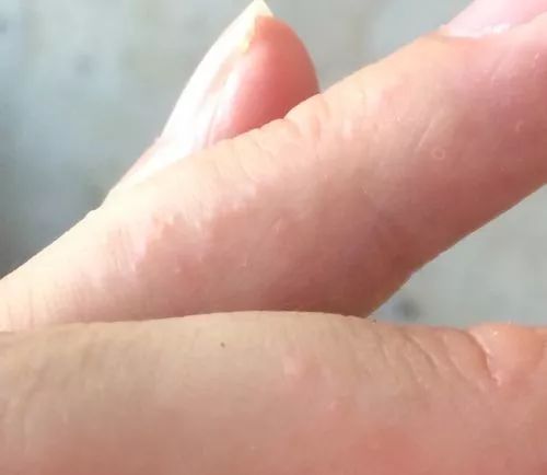 手上长小水泡需不需要把它挑破,夏天手上起小水泡吃什么中药治疗